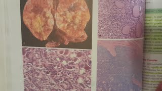 Follicular Poorly differentiated and Anaplastic Thyroid Carcinoma  SPECIAL PATHOLOGY [upl. by Katinka]