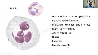 Neutrophilia  GAME 44  Pathology practical slides  MBBS  SRM  Dr GSS  University questions [upl. by Hartfield535]