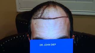 HAIR TRANSPLANT RESTORATION SURGERY 1 YEAR RESULTS BY MEDICAL HAIR TRANSPLANT amp AESTHETICS [upl. by Mailliw]