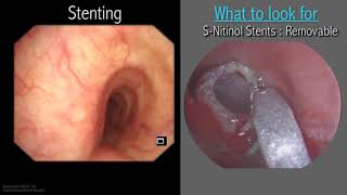 Mastering Bronchoscopy for Thoracic Surgery Chapter 3 [upl. by Eentihw]