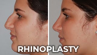 Transforming the Nose A Comprehensive Guide to Rhinoplasty [upl. by Lorrimor862]