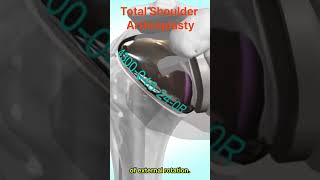 Total shoulder arthroplasty  Principle Procedure and Results [upl. by Haff]