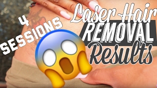 Bikini Laser Hair Removal  Visual Results after FOUR sessions [upl. by Anyr]