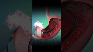 GI Endoscopy Animation  Step by Step Visual Guide for Patients [upl. by Enirahtac]