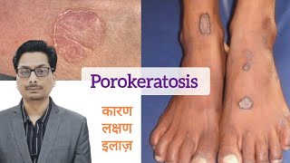 Porokeratosis का कारण लक्षण और इलाज़  Porokeratosis और cancer porokeratosis skincancer cancer [upl. by Nagaet]