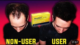 Dutasteride Avodart Ultimate Hairloss Guide by Kevin Mann HairCafe [upl. by Haidabez460]