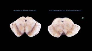 Parkinson Disease Pathophysiology Animation [upl. by Hujsak914]