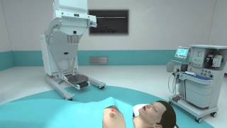 Mobetron®  Intraoperative Electron Radiation Therapy IORT [upl. by Enrol223]