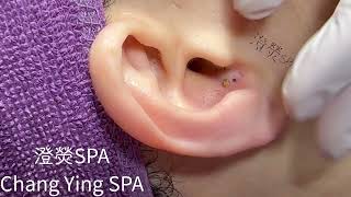 清粉刺推薦耳朵黑頭Blackheads on ear Removal 耳の角栓耳掃除 [upl. by Richara]