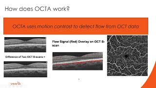 OCT Angiography How to Apply the Data Clinically for Diabetes Management with Dr Julie Rodman [upl. by Enilasor]