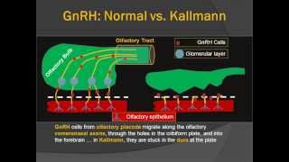 MedPix® COW 687 Kallmann Syndrome [upl. by Akiras]