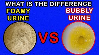 Differences between Foamy Urine Vs Bubbly Urine [upl. by Anivad874]