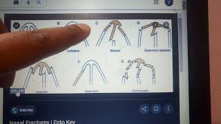 TRAUMA TO THE FACE lecture 2 NASAL BONE FRACTURES detailed explanation with images and treatment [upl. by Chery]