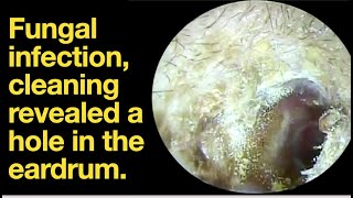 Fungal infection cleaning revealed a hole in the eardrumear wax removal  ear cleaning  ASMR [upl. by Arej]