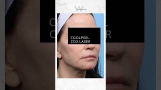 CoolPeel CO2 Laser before and after results to reduce fine lines sun damage and improve texture [upl. by Lizabeth828]