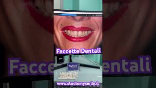 Sorriso perfetto con le faccette dentali faccettedentali dentalveneers carrillas dentist [upl. by Akinorev]