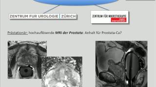 Prostataarterienembolisation minimalinvasive Behandlungsmethode bei Vergrösserung der Prostata [upl. by Kciv]