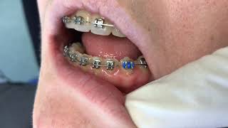 Orthodontic ligation Figure of 8 tie [upl. by Irahs974]