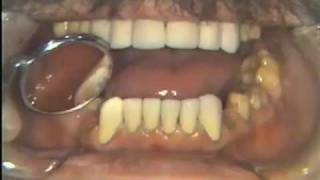 Setting Maxillary Anterior Teeth [upl. by Repmek]