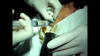 TMJ Arthrocentesis Artrocentesis de Articulacion Temporo Mandibular [upl. by Sucirdor]