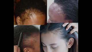 DANGERS OF HAIR BONDING GLUE [upl. by Vanny]