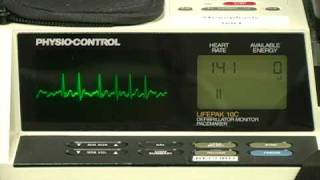 Atrial Fibrillation wRapid Ventricular Response [upl. by Janeva494]