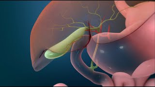 Surgery to Remove Your Gallbladder Open Cholecystectomy [upl. by Ienttirb]