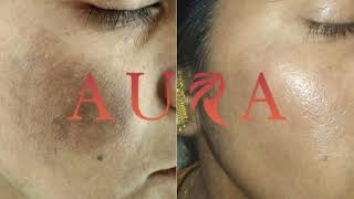 Melasma  Dr Nidheesh Agarwal  Aura Skin and Hair Clinic [upl. by Ennagrom]