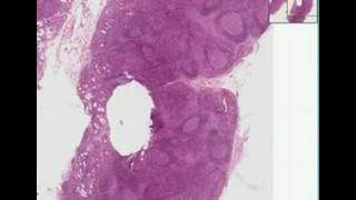 Histopathology Lymph nodeToxoplasmosis [upl. by Sprage]