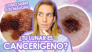 COMO CONTROLAR TUS LUNARES  ¿Es un LUNAR MALIGNO Como saberlo  Recomendaciones de un dermatologo [upl. by Dyal966]