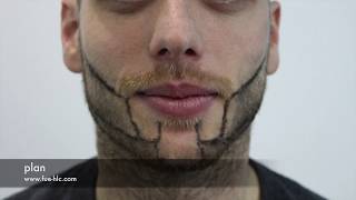 Beard Transplant Beard to Beard Transplant Hairline Clinic [upl. by Eojyllib915]