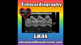 Lipomatous Hypertrophy of the Atrial Septum [upl. by Alberto]