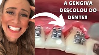 Isso acontece em quem não escova os dentes 😰 dravanessagualda aparelhoortodôntico higiene [upl. by Anertak]