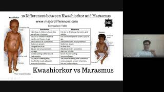 Kwashiorkor and Marasmus What’s the Difference [upl. by Terese]