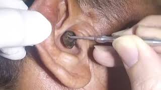 Removing MASSIVE Earwax from Mans Ear [upl. by Linnie]