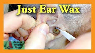 Ear Wax Removal Doctor  Auburn Medical Group [upl. by Chaudoin396]