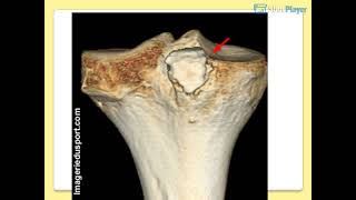 OSTEOLOGIE DU MEMBRE INFERIEUR [upl. by Liuka]