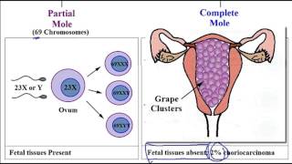 Video 254 Hydatidiform Mole Molar Pregnancy Partial vs Complete Mole amp Associated Risk Factors [upl. by Addi]