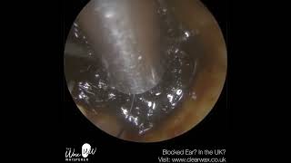 1381  Last Hope Ear Wax Removal for Patient in a lot of Discomfort [upl. by Keller]