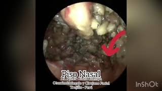 Miasis Nasal  Nasal Myiasis Dr Nimer Carita Trujillo Perú [upl. by Nerte]