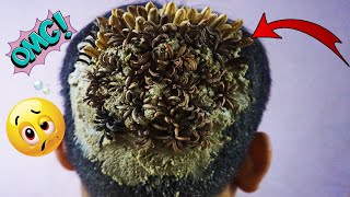 OMG Lots of Tiny Worms On Dandruff Removal 1151 [upl. by Chanda]