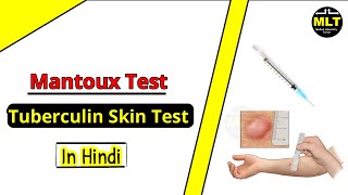 Mantoux Test in Hindi  Tuberculin Skin Test  mantoux test results reading [upl. by Ohs]