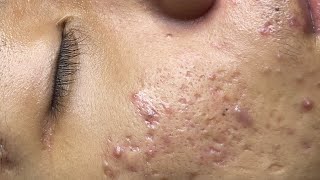 ACNE TREATMENT VU QUYNH MI Acne On Boys Cheek 2024 [upl. by Rimahs]