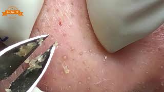 Best Satisfying Nose Plucking Blackheads Whiteheads Removal  Acne Treatment 18 [upl. by Cherri]