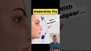 Fixing an Underbite with Headgear Heres How It Works dentallan dentist shorts [upl. by Bordiuk565]