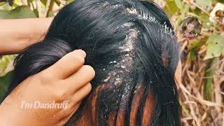 Dandruff Removal Long Hair Guys 76 [upl. by Michigan]