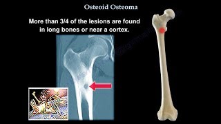 Osteoid Osteoma  Everything You Need To Know  Dr Nabil Ebraheim [upl. by Greff366]