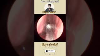 귀지형 콧물 부비동염 축농증 비염 코청소 이비인후과 rhinorrhea rhinitis sinusitis asmr ENT entdoctor [upl. by Okihsoy]