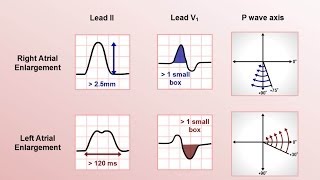 Intro to EKG Interpretation  Chamber Enlargement [upl. by Elnukeda]