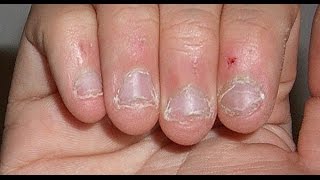 Man Dies Of Nail Biting Habit Doctors Issue Warning To Others [upl. by Katt438]